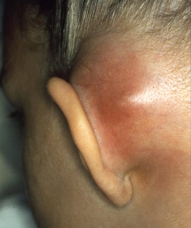 Abscesses, otitis (ear inflammation)