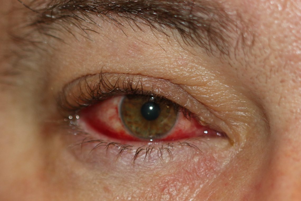 Inflammation of the eyelids (conjunctivitis, blepharoconjunctivitis)