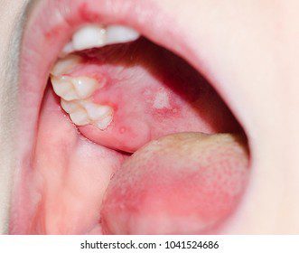 Mouth diseases (necrotic stomatitis, herpes, herpesvirosis)