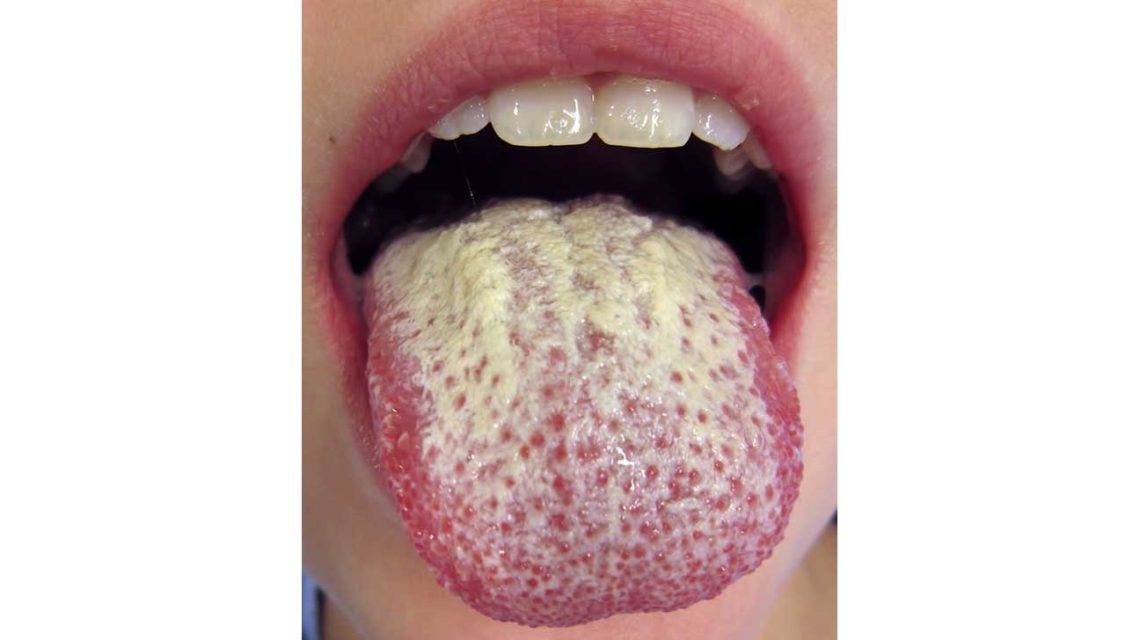 mouth fungus