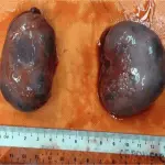 Polycystic kidney and ovary in a cat