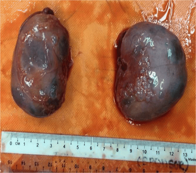 Polycystic kidney and ovary in a cat