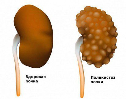 Polycystic kidney disease in cats