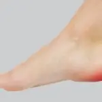 Effective management: what you need to know about spur injuries